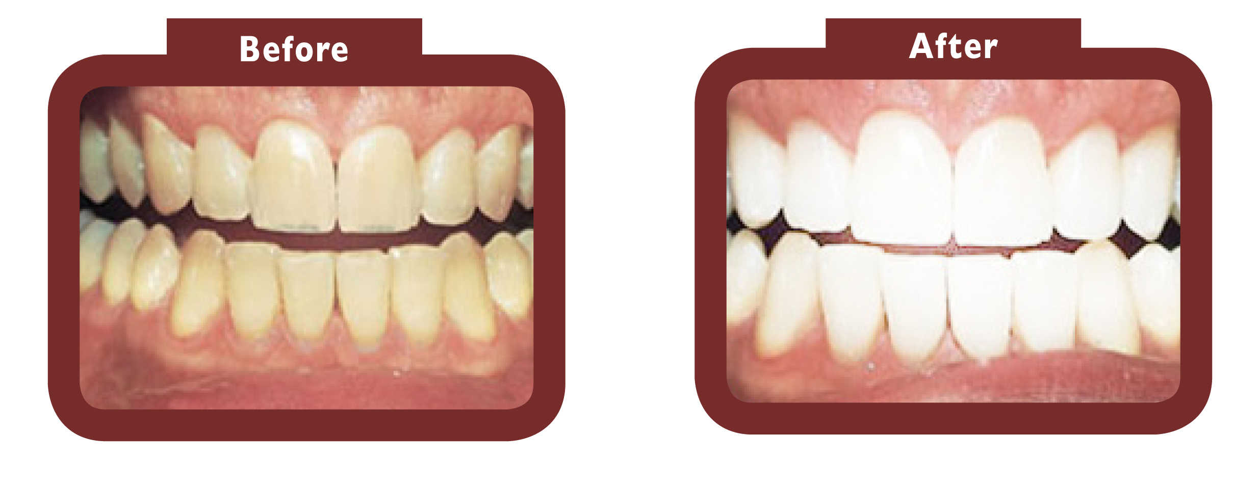 See LA Teeth Whitening before and after results. Contact our team today! Biggleswade