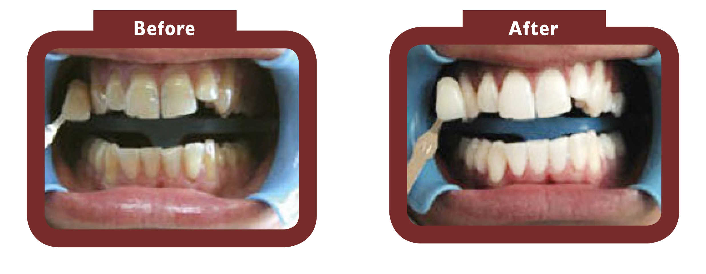 Before and after teeth whitening Biggleswade - LA TEETH Biggleswade