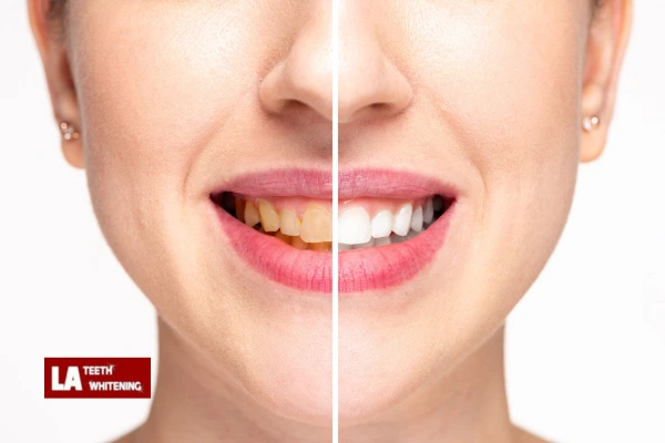 About Us At LA Teeth Whitening Biggleswade Contact us today! Biggleswade