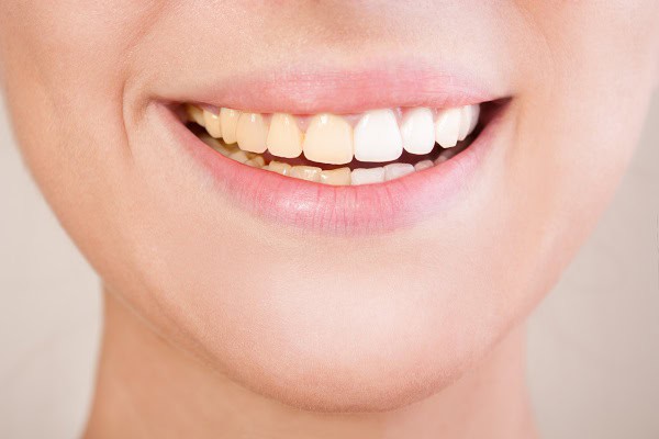 How Does Lifestyle Affect the Type and Severity of Tooth Discoloration Biggleswade