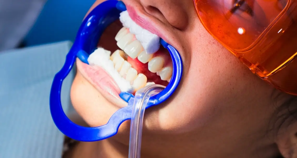 How Long Will Sensitivity Last After Laser Whitening Biggleswade