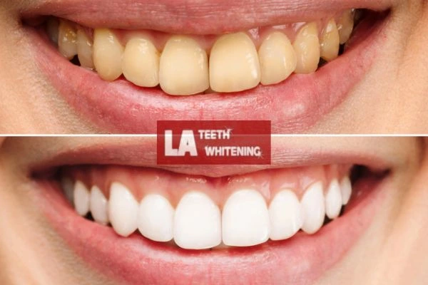 Before and after results - smokers stained teeth results! Biggleswade