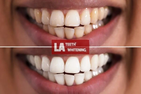 Fast and effective whitening results in one hour. Contact LA Teeth Whitening Biggleswade to book online Biggleswade