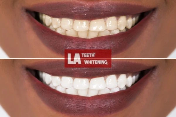 Brighter and white smile - before and after results Biggleswade book online today! Biggleswade