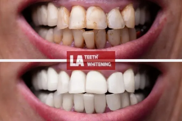 Customer results from LA Teeth Whitening Biggleswade Book today. Biggleswade