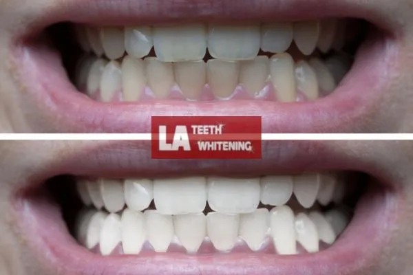 Mens before and after of teeth whitening results Biggleswade Biggleswade