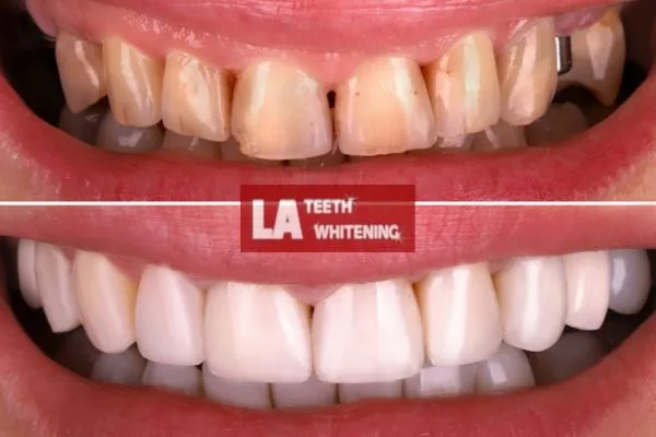 yellow teeth from coffee drinking before and after laser teeth whitening results Biggleswade