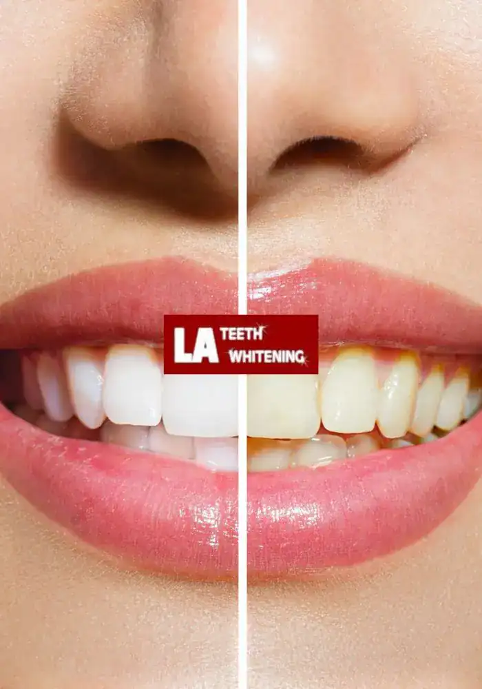 How Can You Ensure a Safe and Comfortable Laser Whitening Experience Biggleswade