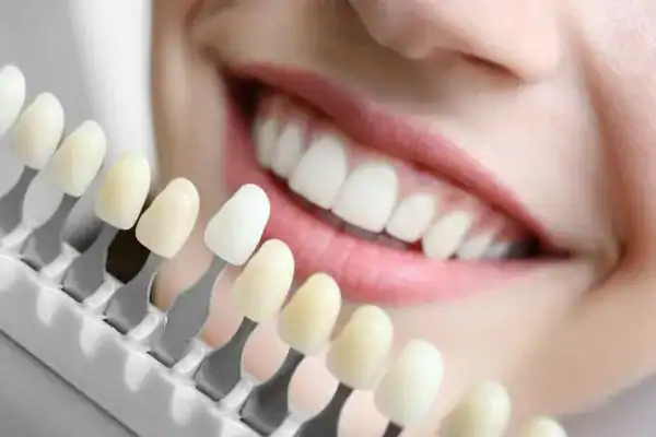 laser whitening Faqs Biggleswade